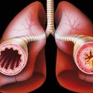 Klebsiella pneumonia (клебсиелла) в моче Klebsiella pneumonia (клебсиелла) в моче