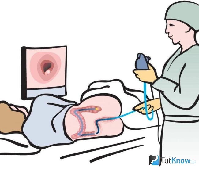 Как проводится подготовка к колоноскопии? Как проводится подготовка к колоноскопии?