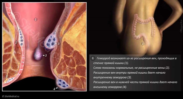 С чем связано появление крови сгустками в кале? С чем связано появление крови сгустками в кале?