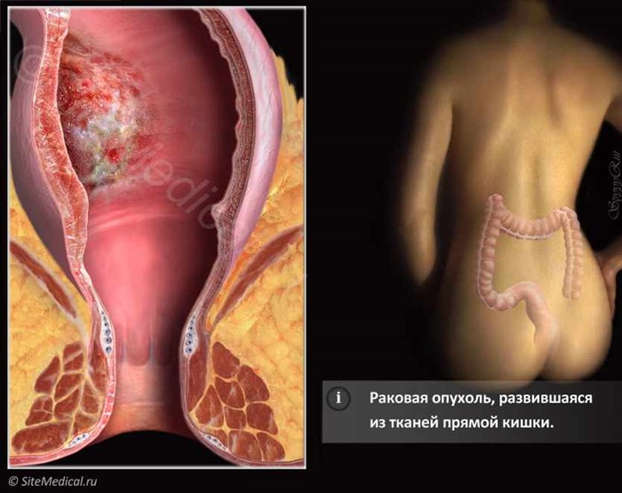 С чем связано появление крови сгустками в кале? С чем связано появление крови сгустками в кале?