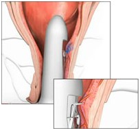 Проведение операции дезартеризации геморроидальных узлов, или геморроя (отзывы и стоимость) Проведение операции дезартеризации геморроидальных узлов, или геморроя (отзывы и стоимость)