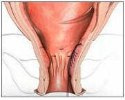 Проведение операции дезартеризации геморроидальных узлов, или геморроя (отзывы и стоимость) Проведение операции дезартеризации геморроидальных узлов, или геморроя (отзывы и стоимость)