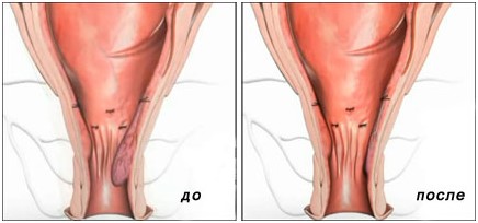 Проведение операции дезартеризации геморроидальных узлов, или геморроя (отзывы и стоимость) Проведение операции дезартеризации геморроидальных узлов, или геморроя (отзывы и стоимость)