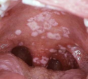 Как происходит лечение грибка на миндалинах? Как происходит лечение грибка на миндалинах?