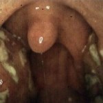 Как происходит лечение грибка на миндалинах? Как происходит лечение грибка на миндалинах?