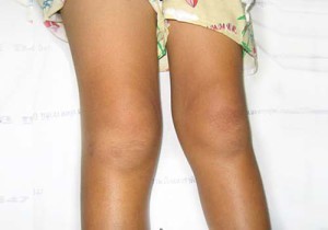 Лечение симптомов ревматоидного артрита народными средствами (травы, баня): отзывы Лечение симптомов ревматоидного артрита народными средствами (травы, баня): отзывы