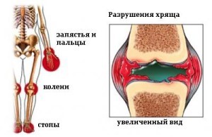 Лечение симптомов ревматоидного артрита народными средствами (травы, баня): отзывы Лечение симптомов ревматоидного артрита народными средствами (травы, баня): отзывы