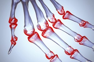 Лечение симптомов ревматоидного артрита народными средствами (травы, баня): отзывы Лечение симптомов ревматоидного артрита народными средствами (травы, баня): отзывы