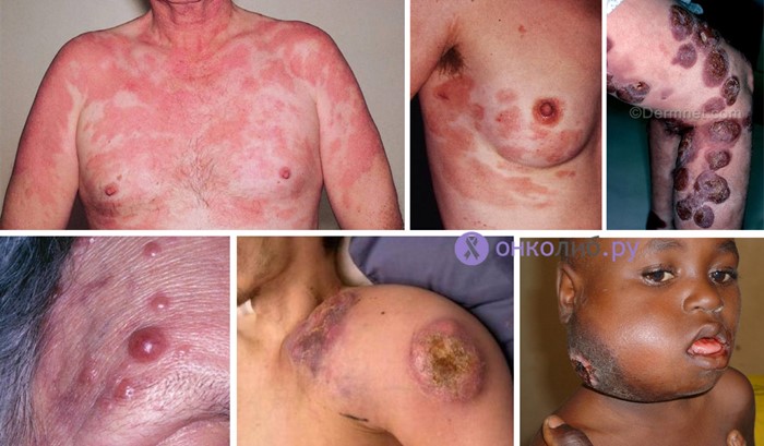 Что такое лимфома? Что такое лимфома?