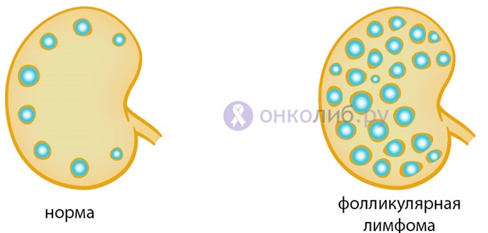 Что такое лимфома? Что такое лимфома?