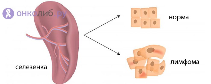 Что такое лимфома? Что такое лимфома?