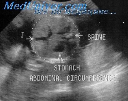 Причины микрогастрии желудка плода Причины микрогастрии желудка плода