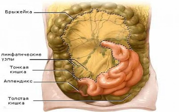 Мезаденит как следствие воспаления лимфоузлов Мезаденит как следствие воспаления лимфоузлов