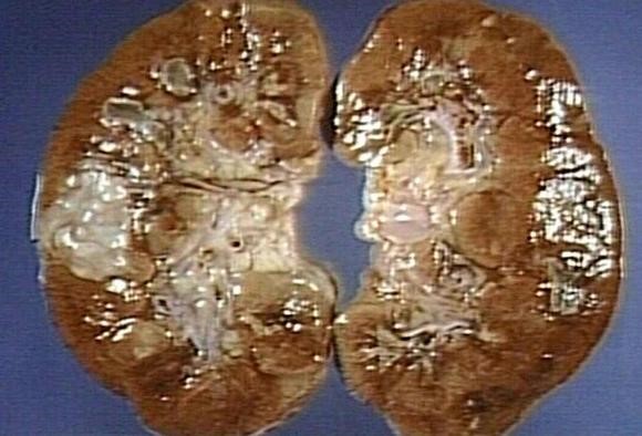 Микролитиаз почек лечению подлежит! Микролитиаз почек лечению подлежит!