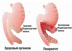 Как следует лечить поджелудочную железу при сахарном диабете Как следует лечить поджелудочную железу при сахарном диабете
