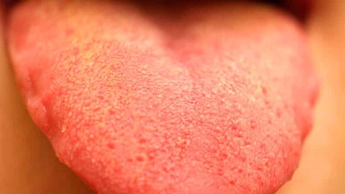 Налет на языке при гастрите: что делать? Налет на языке при гастрите: что делать?