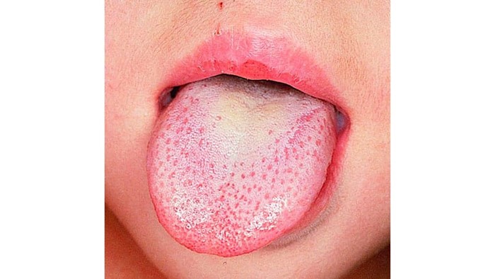 Налет на языке при гастрите: что делать? Налет на языке при гастрите: что делать?