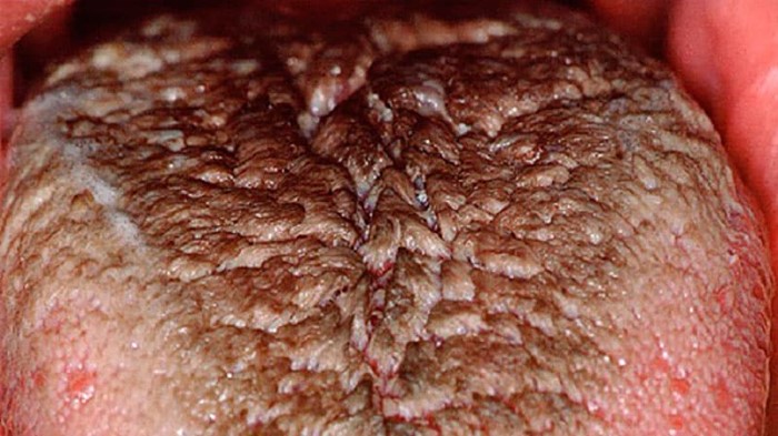 Налет на языке при гастрите: что делать? Налет на языке при гастрите: что делать?