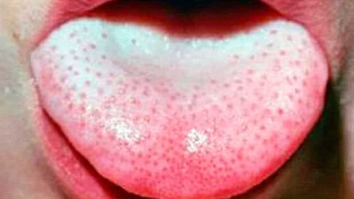 Налет на языке при гастрите: что делать? Налет на языке при гастрите: что делать?