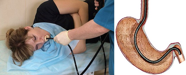 Что надо знать о сфинктере желудка каждому и как предотвратить его заболевания Что надо знать о сфинктере желудка каждому и как предотвратить его заболевания