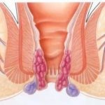 Неполное опорожнение мочевого пузыря Неполное опорожнение мочевого пузыря