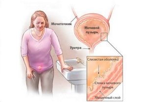Неполное опорожнение мочевого пузыря Неполное опорожнение мочевого пузыря