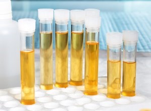 Какая норма лейкоцитов в моче и что делать, если показатели отклоняются от нормы Какая норма лейкоцитов в моче и что делать, если показатели отклоняются от нормы