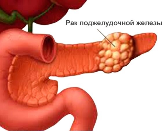 Как проходит опухоли головки поджелудочной железы операция Как проходит опухоли головки поджелудочной железы операция