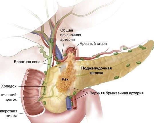 Как проходит опухоли головки поджелудочной железы операция Как проходит опухоли головки поджелудочной железы операция