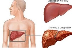 Почему болит живот под ребрами? Самые распространенные причины Почему болит живот под ребрами? Самые распространенные причины