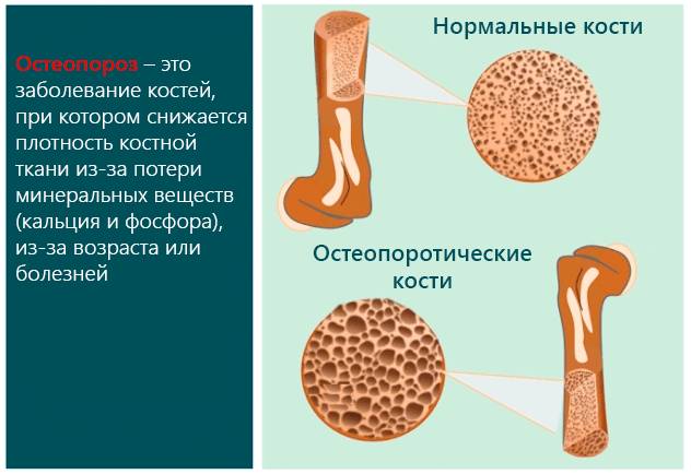 Причины вымывания кальция из организма Причины вымывания кальция из организма