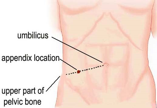 Как проходит вырезание аппендицита? Как проходит вырезание аппендицита?