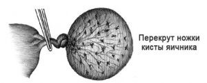 Осложнение кисты яичника: перекрут ножки Осложнение кисты яичника: перекрут ножки