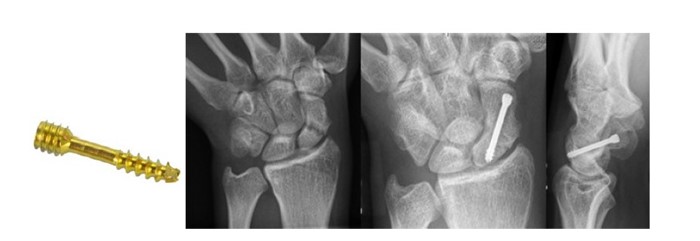 Причины, лечение и восстановление перелома ладьевидной кости кисти Причины, лечение и восстановление перелома ладьевидной кости кисти