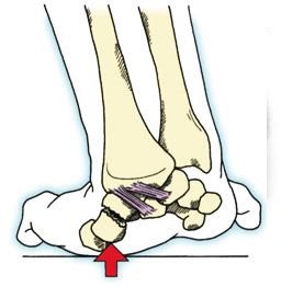 Причины, лечение и восстановление перелома ладьевидной кости кисти Причины, лечение и восстановление перелома ладьевидной кости кисти