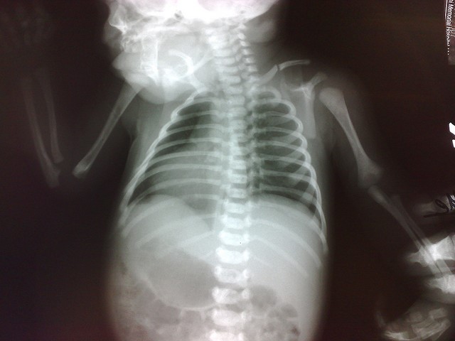 Диагностика и лечение переломов ключицы у ребенка Диагностика и лечение переломов ключицы у ребенка