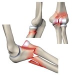 Симптомы и лечение перелома локтевой кости руки Симптомы и лечение перелома локтевой кости руки