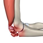 Симптомы и лечение перелома локтевой кости руки Симптомы и лечение перелома локтевой кости руки