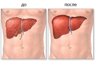 Можно ли пересаживать печень при раке с циррозом? Можно ли пересаживать печень при раке с циррозом?
