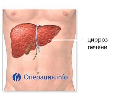 Можно ли пересаживать печень при раке с циррозом? Можно ли пересаживать печень при раке с циррозом?