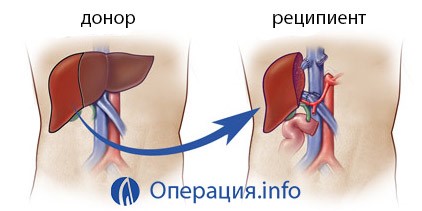 Можно ли пересаживать печень при раке с циррозом? Можно ли пересаживать печень при раке с циррозом?