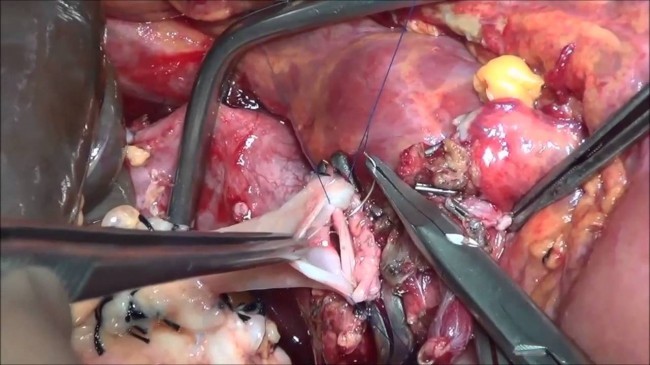 Пиелокаликоэктазия – расширение чашечно-лоханочной системы почек Пиелокаликоэктазия – расширение чашечно-лоханочной системы почек