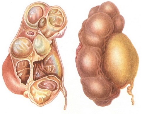 Пиелокаликоэктазия – расширение чашечно-лоханочной системы почек Пиелокаликоэктазия – расширение чашечно-лоханочной системы почек