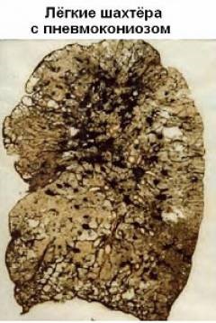 Пневмосклероз Пневмосклероз
