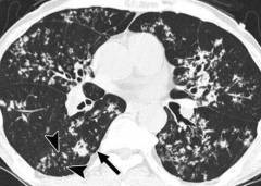 Пневмосклероз Пневмосклероз