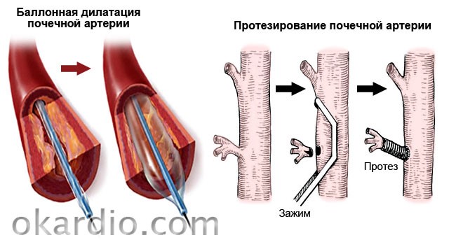 Почечное давление: причины, симптомы и лечение, как лечить артериальную гипертензию Почечное давление: причины, симптомы и лечение, как лечить артериальную гипертензию