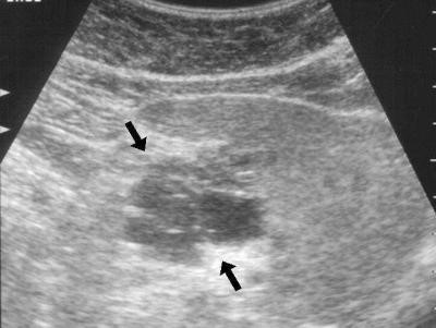 Что делать если эхогенность поджелудочной железы повышена? Что делать если эхогенность поджелудочной железы повышена?