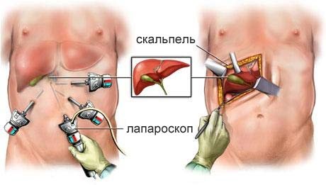 Причины возникновения и терапия холестеринового полипа в желчном пузыре Причины возникновения и терапия холестеринового полипа в желчном пузыре