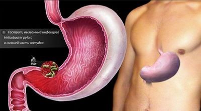 Что делать, если болит желудок после приема антибиотиков? Что делать, если болит желудок после приема антибиотиков?