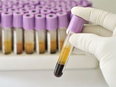 Почему бывает высокий билирубин в крови? Почему бывает высокий билирубин в крови?